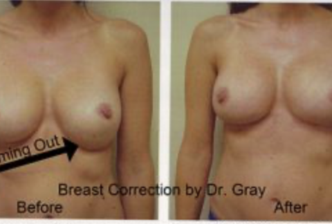 Type II Deformity on the left.